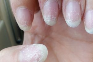 Unhas de gel podem provocar cancro de pele