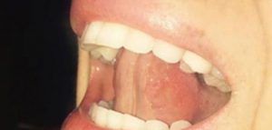lingua dentes