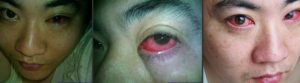 Um homem de 40 anos foi diagnosticado com cancro nos olhos e a causa é um alerta para todos nós.