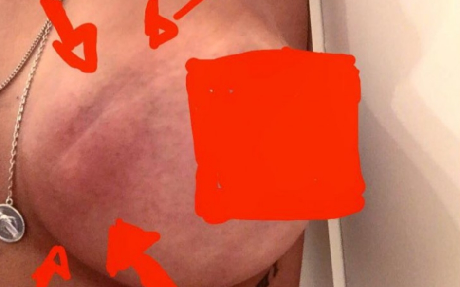 O tumor de Sofia Ribeiro