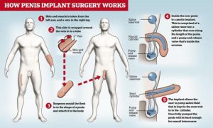 Nasceu sem pénis e só perdeu a virgindade aos 45 anos após cirurgia