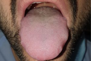 Língua dilatada e com marcas dos dentes nas laterais de um paciente com covid-19