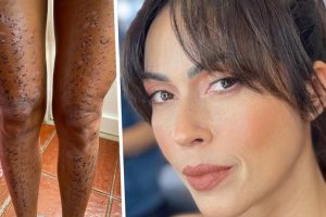 Débora Monteiro mostra pernas após depilação a laser que correu mal