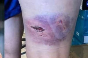 O estado da perna da jogadora do PSG após ataque bárbaro