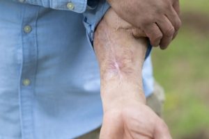 Homem fica 6 anos com pénis no braço após infecção sanguínea