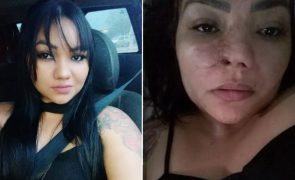 Mulher perde parte do nariz após cirurgia estética: «Tenho vergonha»