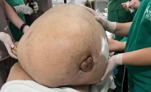 Mulher com tumor de 46 quilos achava estar apenas gorda [fotos]