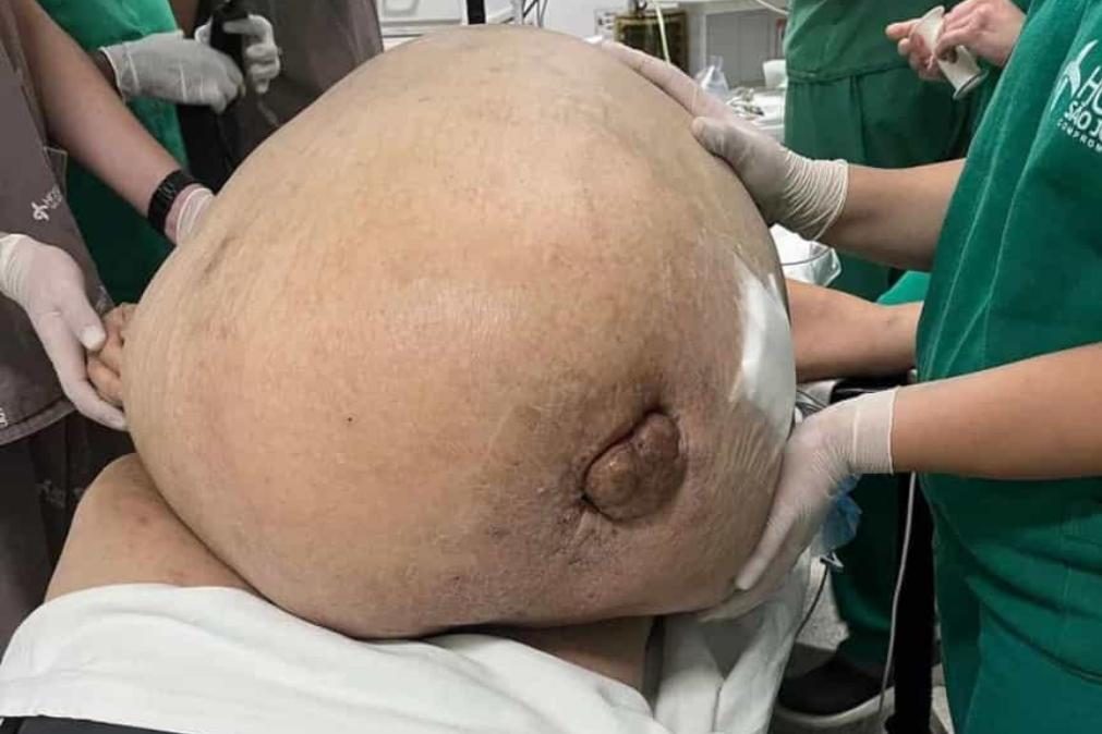 Mulher com tumor de 46 quilos morre 11 dias após cirurgia