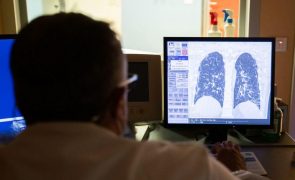 Dados do cancro do pulmão mostram melhores resultados dos tratamentos