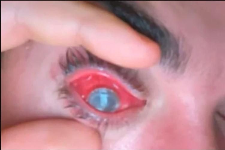 Jovem de 21 anos fica cego depois de dormir com lentes de contato