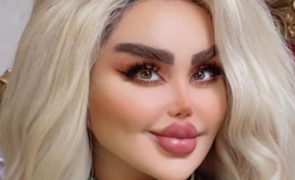 Barbie da vida real irreconhecível após 43 cirurgias plásticas