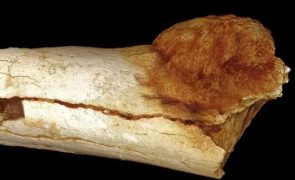 Este é o caso de cancro mais antigo que se conhece