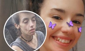 Viciada em drogas ultrapassa vício e revela imagens de 'antes e depois'