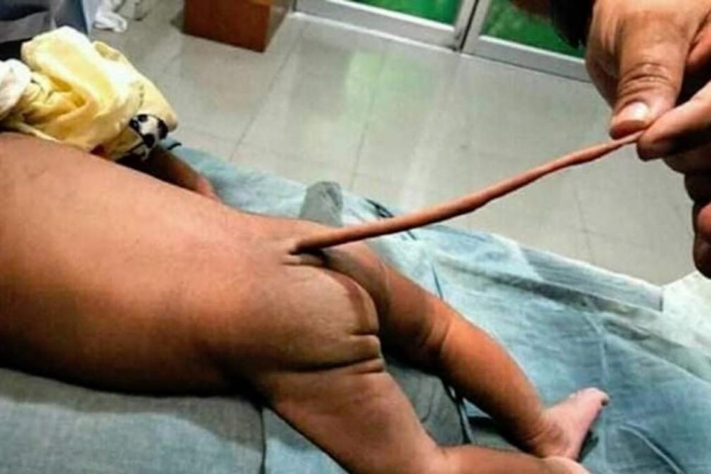 Bebé nasce na Colômbia com cauda de 13 centímetros