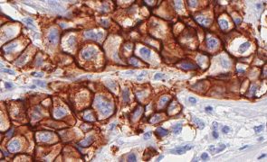 Universidade de Coimbra procura mulheres com carcinoma da mama para ensaio clínico