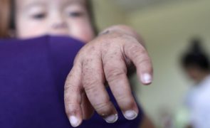 Número de casos de sarampo sobe para 16 em Portugal