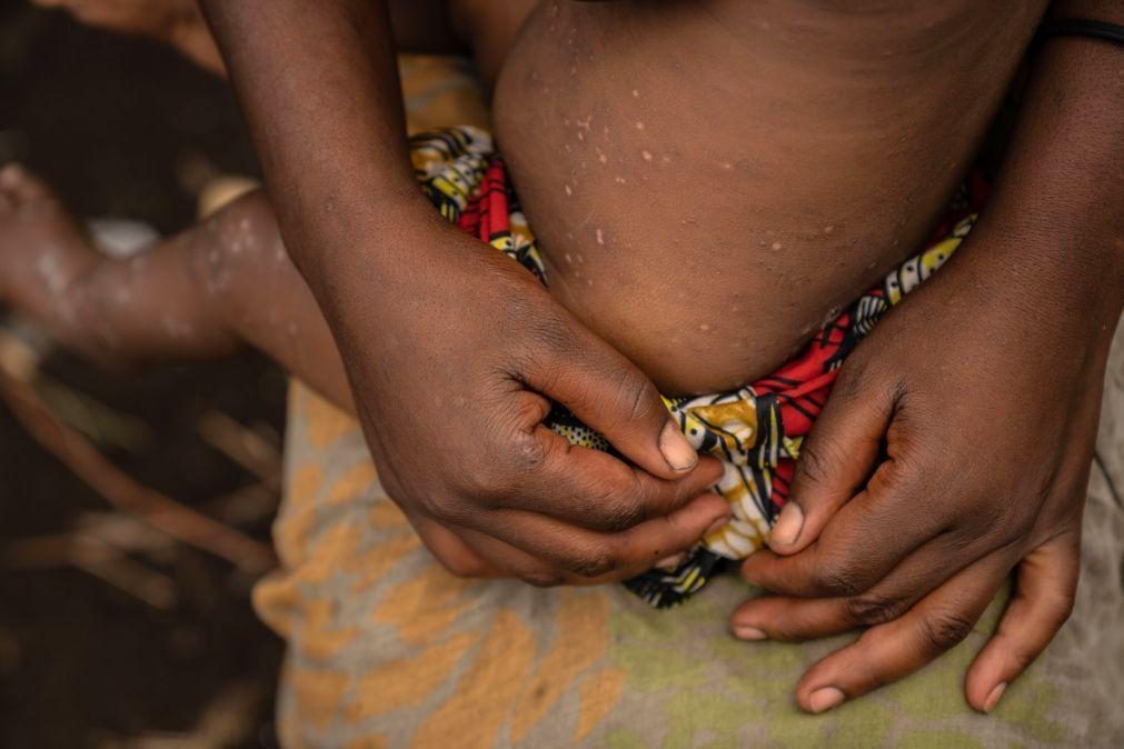 Mpox: Casos em crianças multiplicaram-se por 75 na província congolesa mais afetada