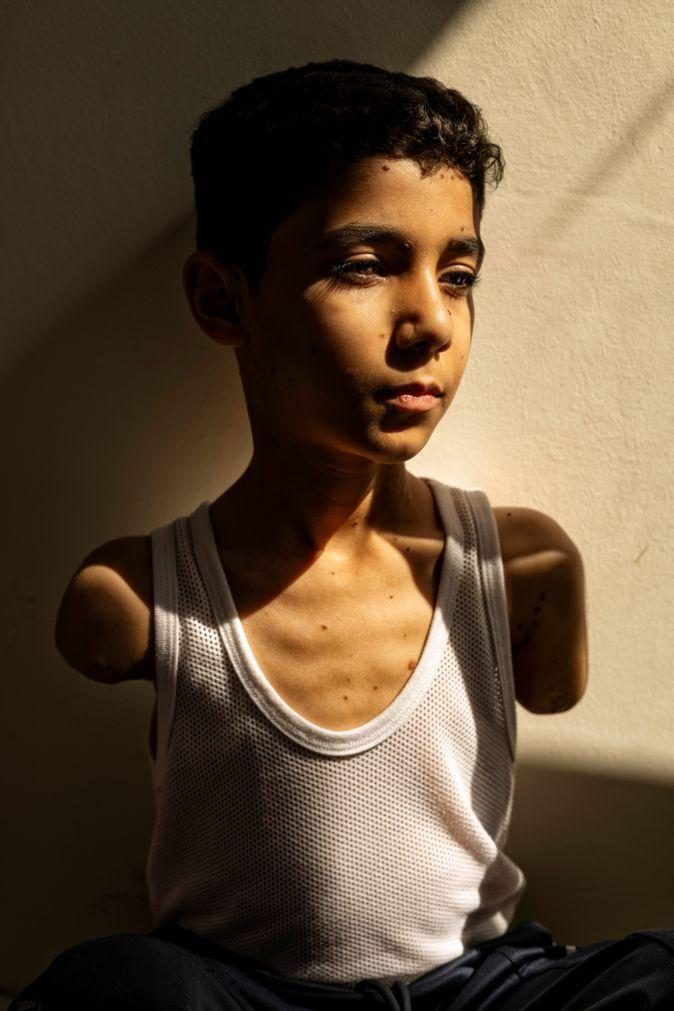 Guerra de Gaza na fotografia do ano do World Press Photo com menino palestiniano mutilado