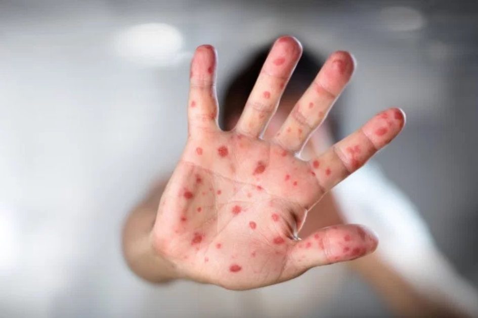 Menos 13 mil bebés vacinados num mês pode significar novo surto de sarampo