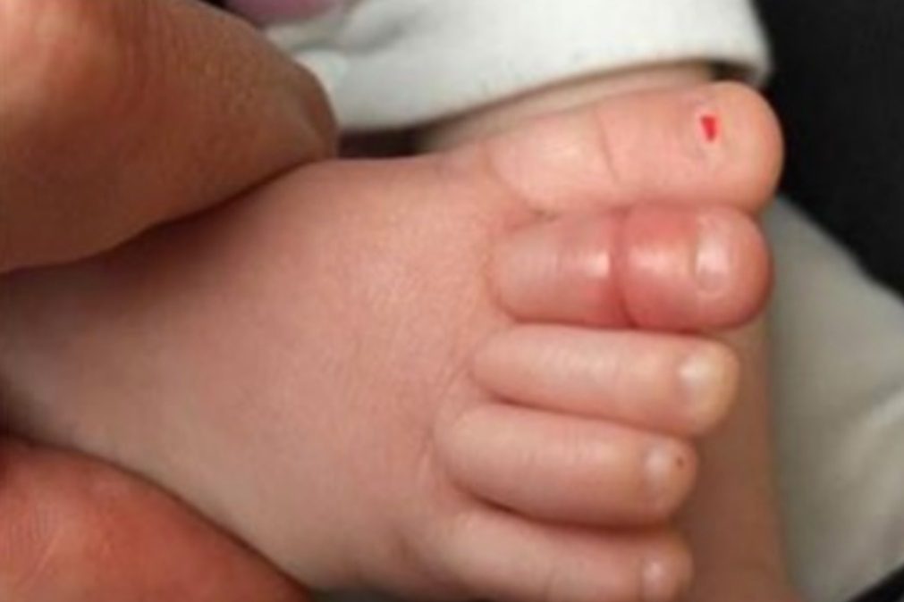 Bebés em risco. Sinal corporal pode revelar doença grave!