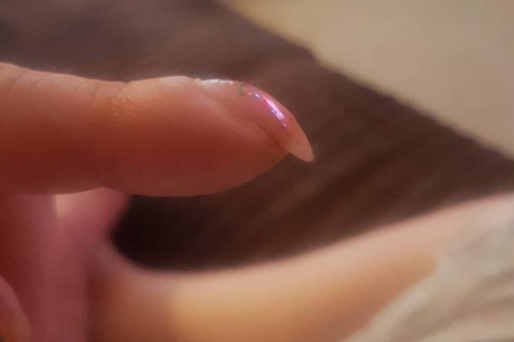 Mulher descobre que tem cancro depois de partilhar foto das unhas