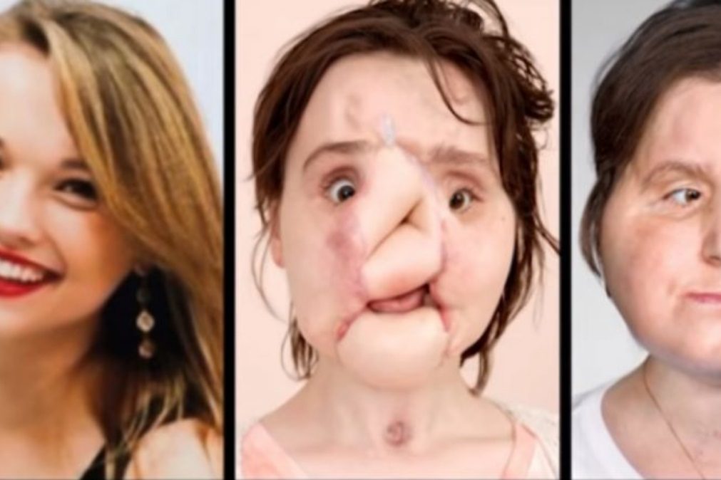 Como Katie perdeu o rosto e como uma operação lhe mudou a vida