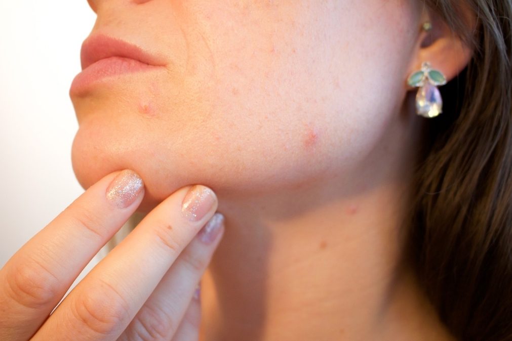 Vacina contra a acne pode estar prestes a chegar