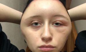 Jovem sofre reação alérgica depois de pintar o cabelo e fica desfigurada