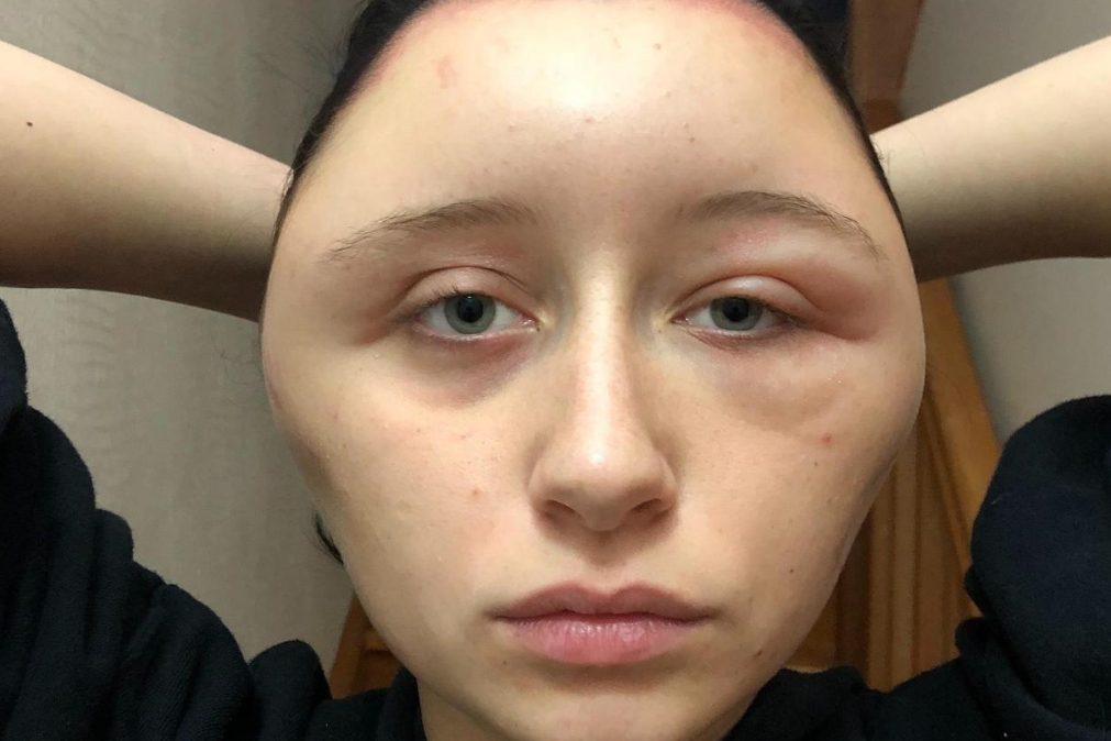 Jovem sofre reação alérgica depois de pintar o cabelo e fica desfigurada