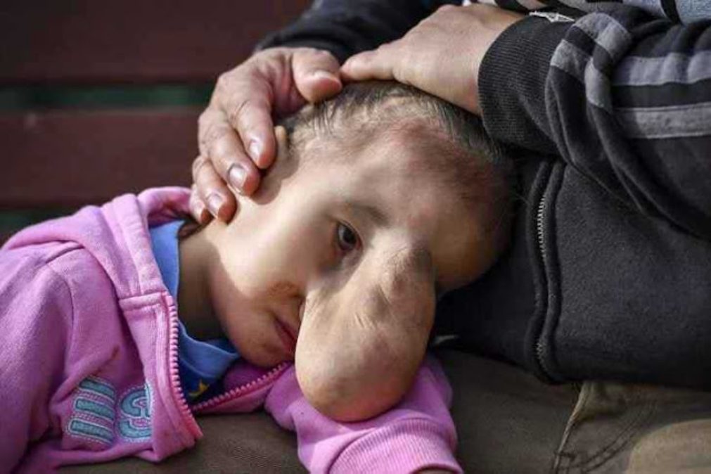 Médico opera gratuitamente menina pobre com tumor no rosto
