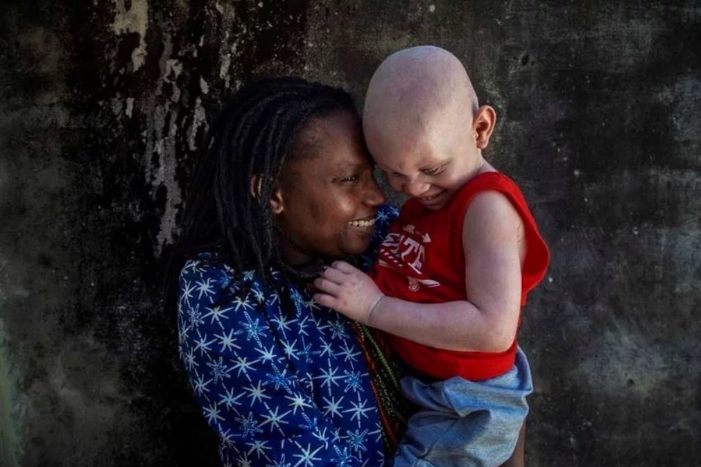 Crianças albinas em Moçambique são «amplamente discriminadas e estigmatizadas»