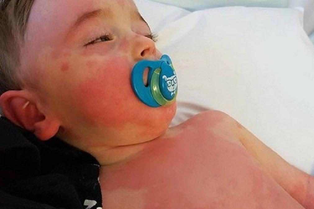 Holanda: 19 crianças com síndrome inflamatória associada à covid-19