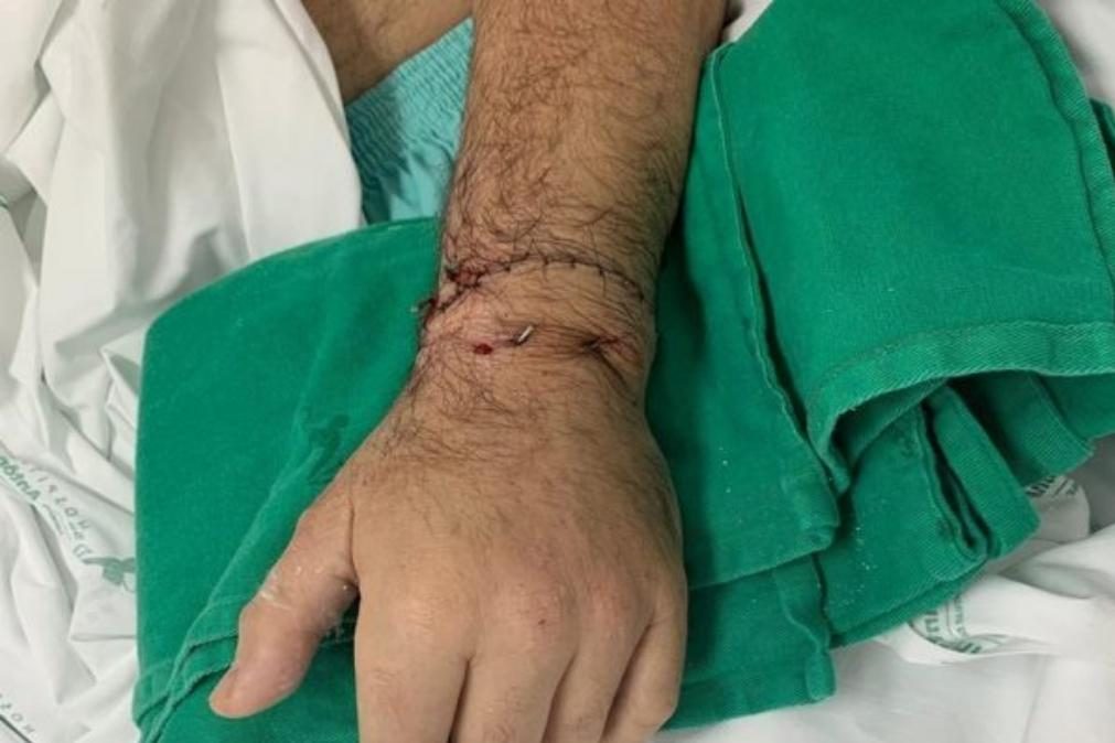 Hospital de Santo António reimplanta mão a paciente que a perdeu em rixa