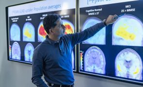 Alzheimer atinge determinadas regiões cerebrais antes da idade que se julgava
