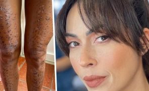Débora Monteiro mostra pernas após depilação a laser que correu mal