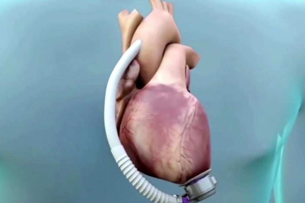 Hospital de Coimbra implanta primeiro coração artificial [vídeo]