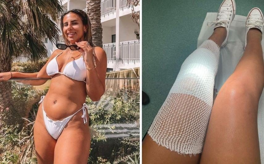 Joana Albuquerque revela imagem impressionante da perna após ser atacada por cão