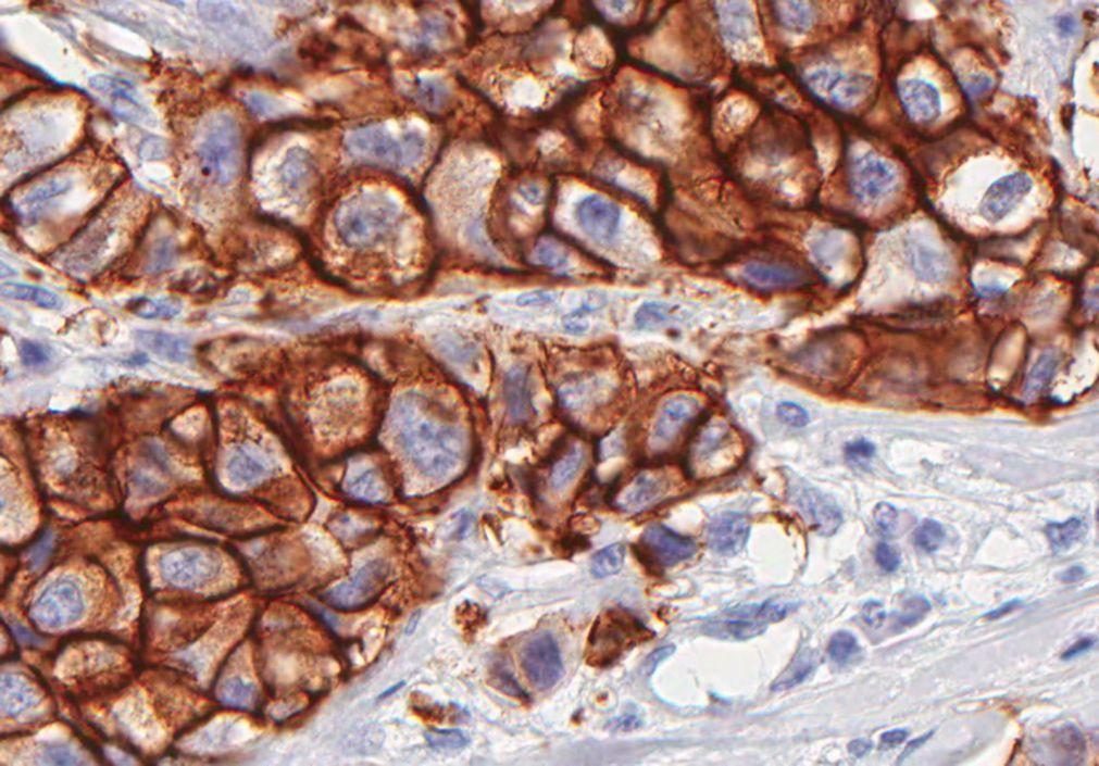 Descoberta proteína que prevê eficácia da quimioterapia em doentes com cancro da mama