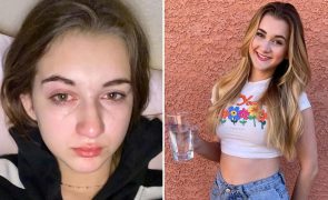 Jovem de 15 anos alérgica a água não pode beber nem chorar
