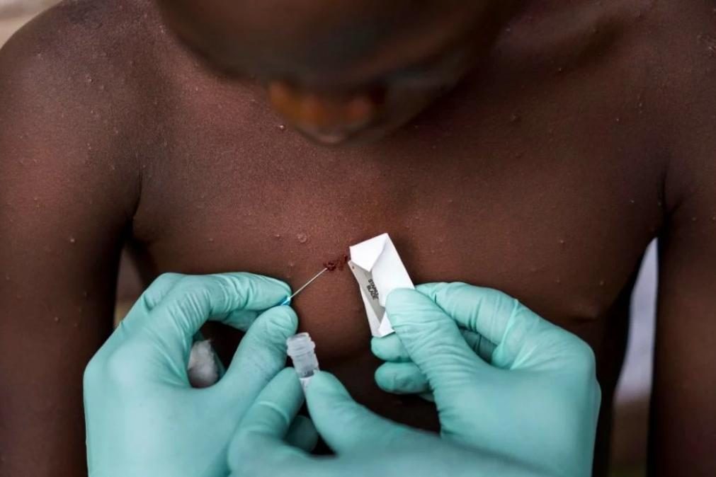 Vinte casos de varíola dos macacos detetados em Portugal