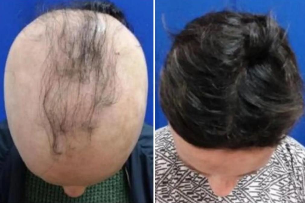 Medicamento recupera cabelo de pacientes com alopecia areata